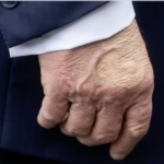 Screenshot of news clip about Trump’s bruised hand.
