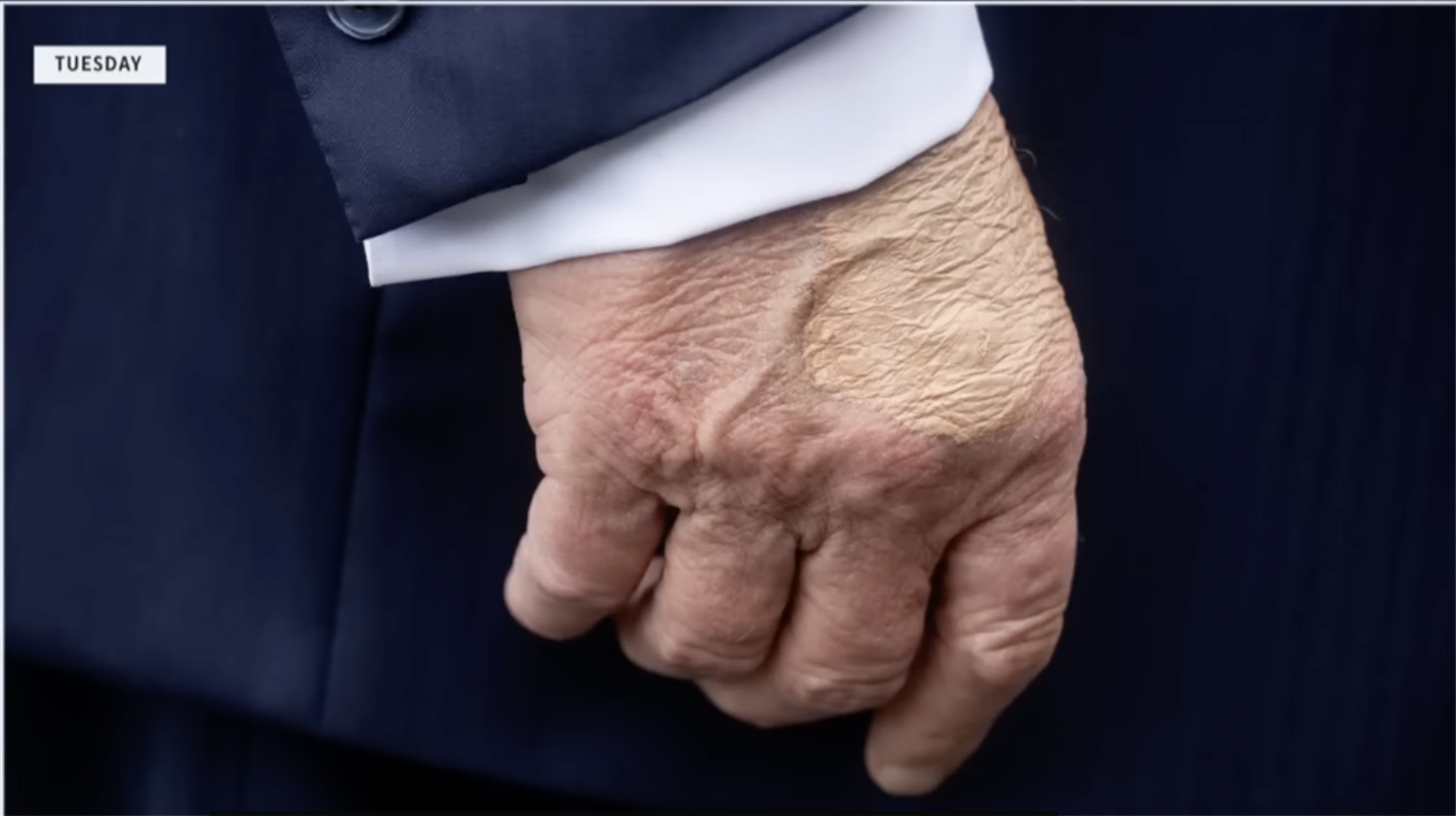 Screenshot of news clip about Trump’s bruised hand.